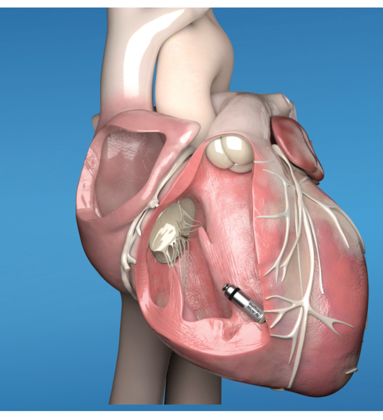 NYU Winthrop implants new generation of pacemakers in major cardiac advancement NYU Winthrop implants new generation of pacemakers in major cardiac advancement