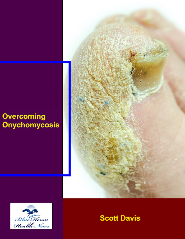 Overcoming Onychomycosis Reviews – Here’s My Experience